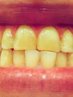 Bruxism