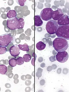 Leukemia