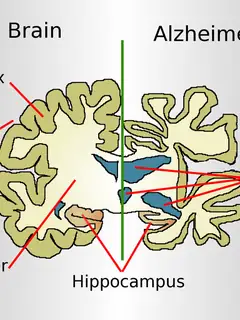 Alzheimer's disease