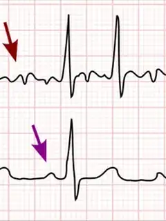 Atrial fibrillation