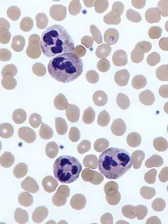 Neutrophilia