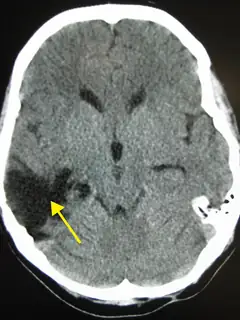 Brain injury