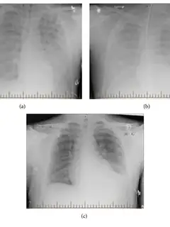 Syndrome pulmonaire à Hantavirus