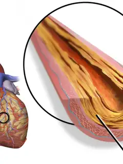 Atherosclerosis